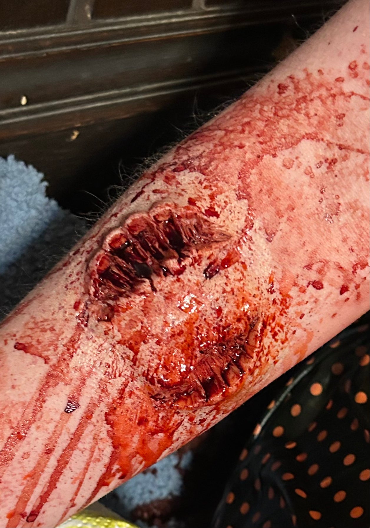 Bite #1
