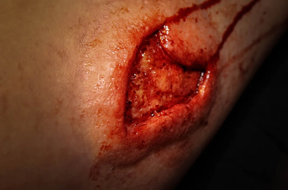 Fatty Wound